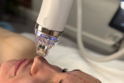 Radiofrekwencja mikroigłowa – naturalny lifting