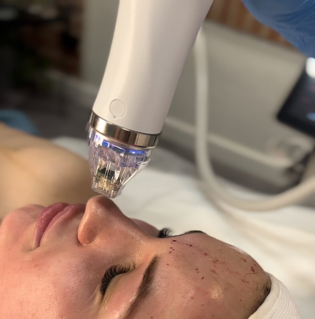 Radiofrekwencja mikroigłowa – naturalny lifting